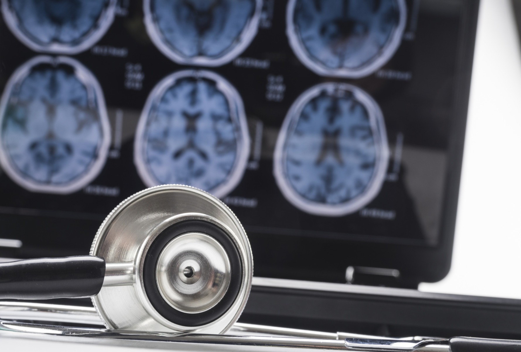 Peste 12.000 de cazuri noi de Alzheimer raportate anul trecut de medicii de familie / Numeroase cazuri rămân nediagnosticate în România